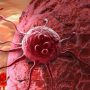 Hiểu đúng về khối u trong cơ thể